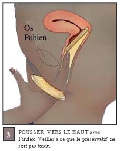 POUSSER VERS LEa HAUT avec l index. Veiller a ce que le femidom ne soit pas tordu.