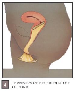 le femidom est bien place au fond